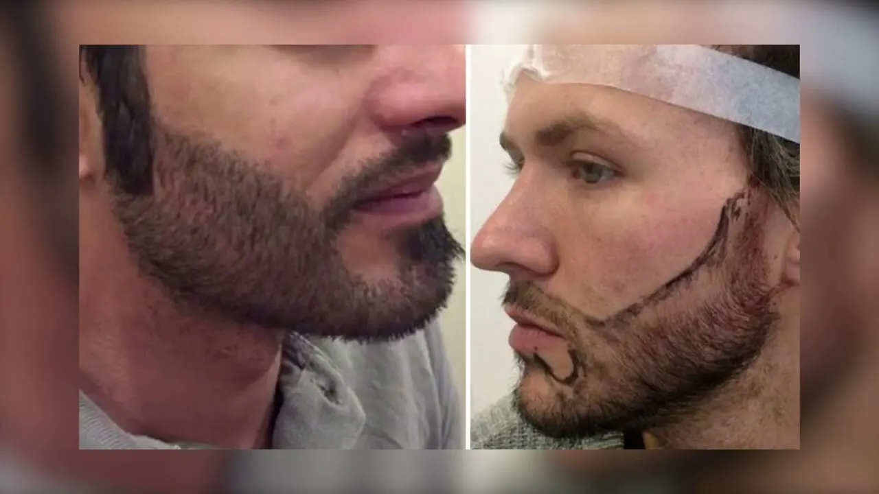Es una pérdida de tiempo si usas minoxidil y eres lampino: guía útil