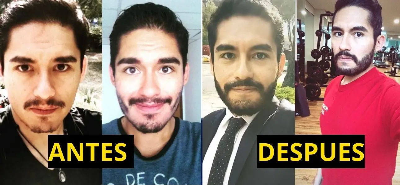 Antes y despues con minoxidil