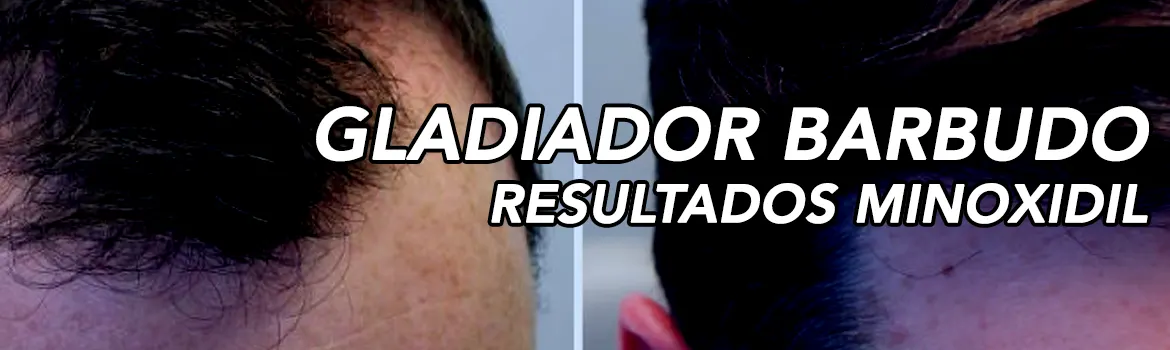 Resultado con minoxidil: explicado sin vueltas: lo que revisaría antes de empezar